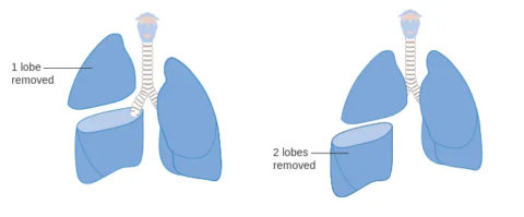 Video-Assisted Lobectomy | Heart & Lung Surgeons Durban